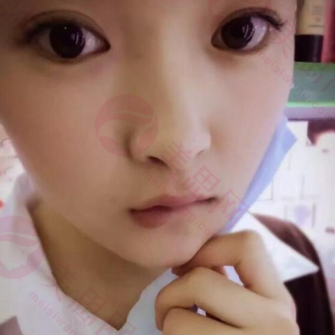 上海伊萊美醫療美容醫院江華醫生硅膠隆鼻 案例分享