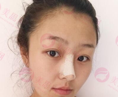 广州紫馨医疗美容硅胶隆鼻前后对比变化太大了，好漂亮