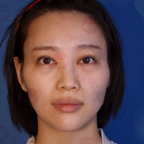 上海首尔丽格美容医院下颌角颧骨磨骨手术 6个月变化