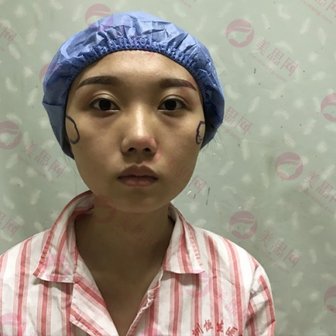 上海九院整形外科顴骨降低手術術前術后對比實圖分享