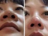 假体隆鼻会有疤痕增生的情况吗?