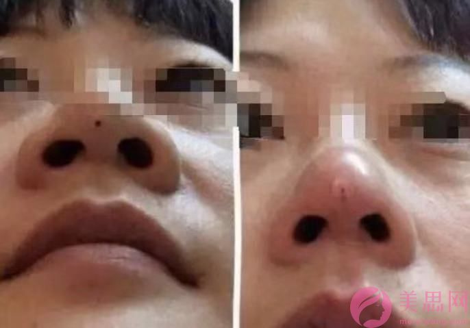 假体隆鼻会有疤痕增生