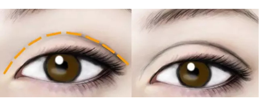为什么有的全切双眼皮手术痕迹重，全身双眼皮痕迹重是问题导致?