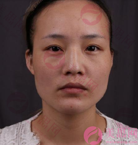 上海九院整形外科下頜角磨骨前后對比，臉小了一圈