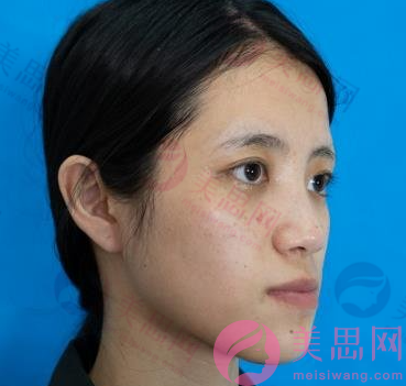 上海九院整形外科面部不對稱矯正磨骨手術，臉型變好看