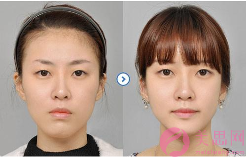 偏颌两边脸不对称的改善方法