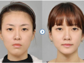 偏颌两边脸不对称的改善方法有哪些 ?可以矫正对称嘛