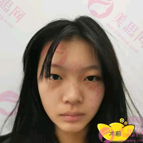 北京爱慕医疗美容医院全切双眼皮分享，眼睛变的又大又