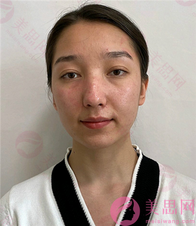 北京愛慕醫療美容診所硅膠隆鼻鼻頭變的精致多了