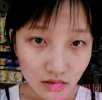 北京幻颜医疗美容切开双眼皮两个月，精神小妹变仙女