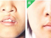 广州二期修复唇腭裂哪家医院好?