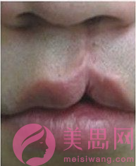 上海唇腭裂手术价格