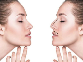 硅胶隆鼻和膨体隆鼻有什么区别?