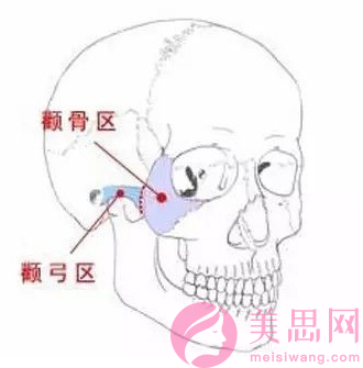 颧骨内推手术