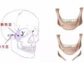 颧骨内推手术和下颌角手术可以一起做吗?