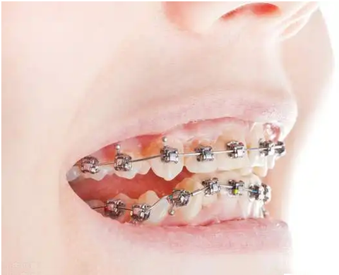 种植牙齿多少钱？2022牙科收费价格表