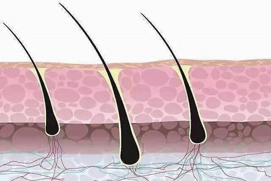 解析：移植一个毛囊单位可能会长出多根头发