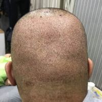 哈尔滨博士园头顶加密植发术后分享