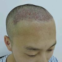 重庆碧莲盛秃顶植发术后效果分享来了