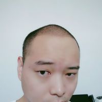 杭州新生秃顶植发术后分享