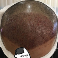 广州熙朵秃顶植发术后效果分享