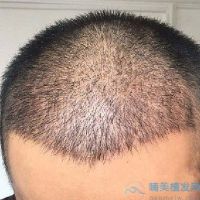 广州熙朵秃顶植发术后效果分享