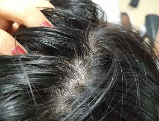 头螨会导致脱发吗？怎样预防治疗头螨脱发？