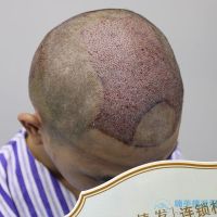 无锡百年秃顶植发术后案例分享