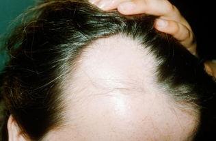 植发种的头发能保持多久？