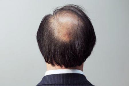 脱发有危害吗？应该怎样治疗？