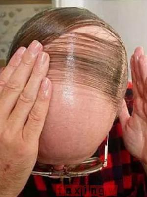 植发治疗秃顶效果好不好？