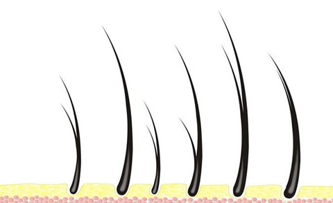 阴毛种植有哪些副作用？