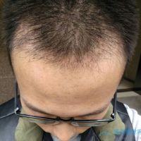 郑州新生秃顶植发，术后一年效果很浓密