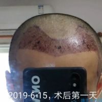 哈尔滨博士园秃顶植发案例分享