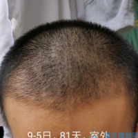 哈尔滨博士园秃顶植发案例分享