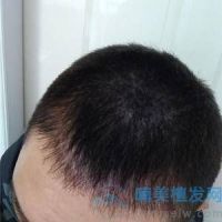 杭州新生发际线种植，有头发的感觉真的棒