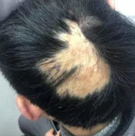 头皮有疤痕可以植发来掩盖吗?