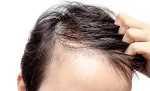 脂溢性脱发和肾虚脱发有什么区别?