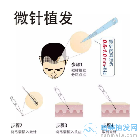 微针植发