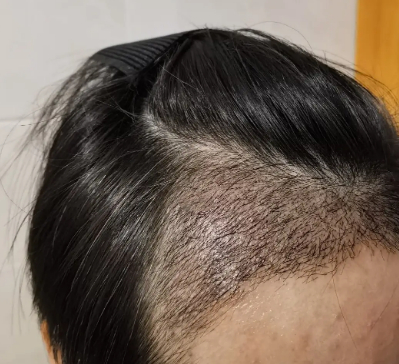 植发后应激性脱发的原因是什么?能长回来吗?