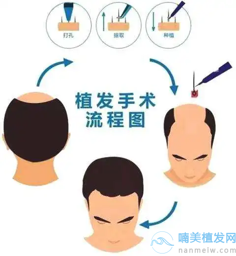 上海薇琳植发流程
