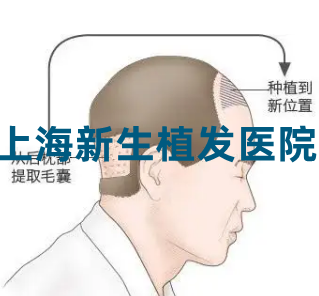 上海新生植发医院怎么样?靠谱吗?