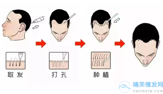 合肥大麦植发流程