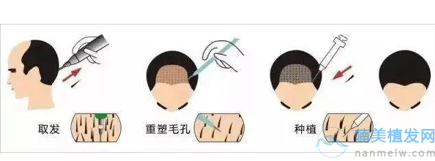 福州碧蓮盛植發(fā)怎么樣