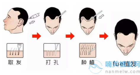 深圳發(fā)際線植發(fā)