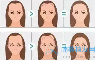 深圳女士發(fā)際線植發(fā)