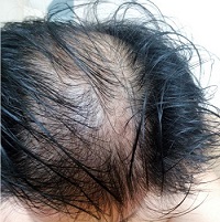 武汉新生和煕朵植发医院治疗脂溢性脱发如何？