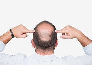 为什么生活中很多秃顶的不去做植发手术？