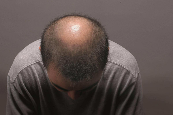 植发整形头发种植术详解：附手术、治疗、康复及注意事项
