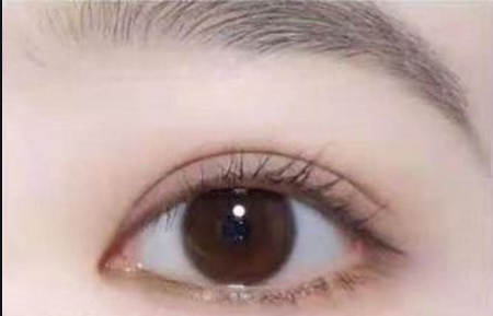 双眼皮